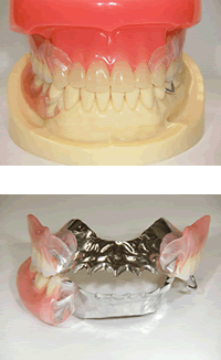 アルティメットクリア義歯