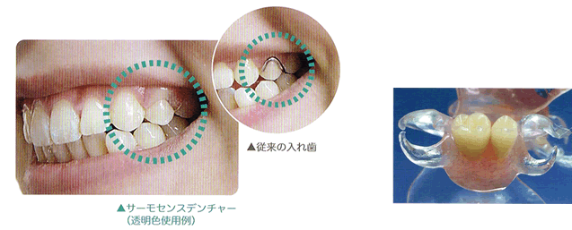 従来の入れ歯とサーモセンスデンチャーの使用例比較