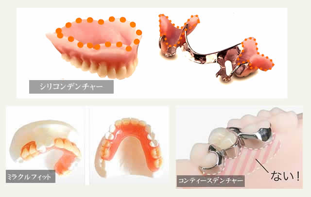 当院で採用している義歯